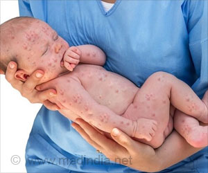 Measles Outbreaks in Texas Measles Outbreaks in Texas