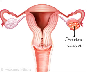  Ovarian Cancer Can Be Detected Using This Test