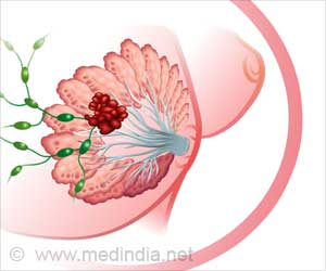 Modified Drug Combo Reduces Breast Cancer Recurrence Risk Modified Drug Combo Reduces Breast Cancer Recurrence Risk