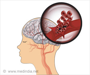 Eliminating Visual Stimulation may Help Counter Symptoms of Spatial Neglect After Stroke: Study Eliminating Visual Stimulation may Help Counter Symptoms of Spatial Neglect After Stroke: Study