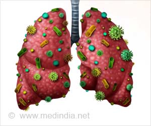Pneumonia causing bacteria Attack Using Bleaching Agent Pneumonia causing bacteria Attack Using Bleaching Agent