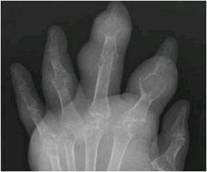 Risk Factors That Contribute to Gout Identified Risk Factors That Contribute to Gout Identified