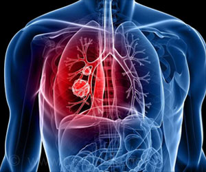 First-line Therapy for Lung Cancer Patients Identified First-line Therapy for Lung Cancer Patients Identified