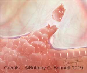 Breast Cancer Cells 'Stick Together' to Spread Throughout the Body