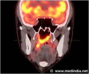 AI Improves the Diagnosis of Patients With Head and Neck Cancers AI Improves the Diagnosis of Patients With Head and Neck Cancers