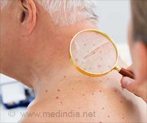 Melanoma Treatment is Linked With B Cells Melanoma Treatment is Linked With B Cells