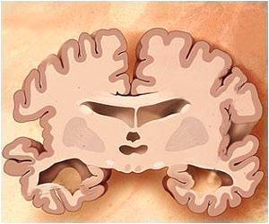 Areas of the Retina That Change in Mild Alzheimer's Disease Discovered Areas of the Retina That Change in Mild Alzheimer's Disease Discovered