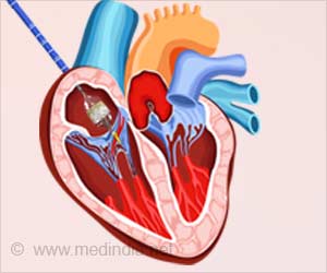 Cardiac Tissue Remodeling After Aortic Valve Replacement Procedures Explored Cardiac Tissue Remodeling After Aortic Valve Replacement Procedures Explored
