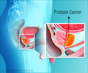 Targeted Radiotherapy Could cut Prostate Cancer Treatment Time Targeted Radiotherapy Could cut Prostate Cancer Treatment Time