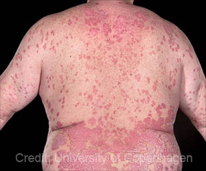 Psoriasis Drug Can Treat Osteosarcoma, Says Study Psoriasis Drug Can Treat Osteosarcoma, Says Study