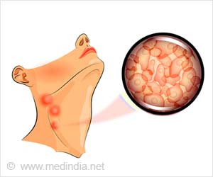 New Factor in the Development of Childhood Lymphoma: Study New Factor in the Development of Childhood Lymphoma: Study