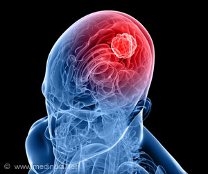 New Promising Therapeutic Target for Glioblastoma Identified New Promising Therapeutic Target for Glioblastoma Identified