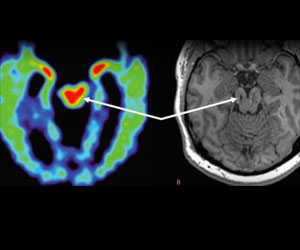 MRI can Relieve Doubt While Diagnosing Minor Strokes MRI can Relieve Doubt While Diagnosing Minor Strokes