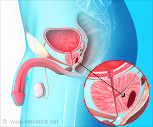 New Drug Candidates for Prostate Cancer Identified New Drug Candidates for Prostate Cancer Identified