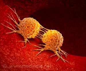 AI Predicts Radiation Treatment Side Effects for Head and Neck Cancer Patients AI Predicts Radiation Treatment Side Effects for Head and Neck Cancer Patients