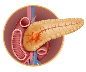 Study Reveals How Pancreatic Cancer Fuels Its Growth Study Reveals How Pancreatic Cancer Fuels Its Growth