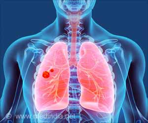 New Cancer Drug Benefits Lung Cancer Patients New Cancer Drug Benefits Lung Cancer Patients