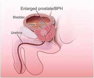 Radiotherapy Not Necessary For Men After Prostate Cancer Surgery Radiotherapy Not Necessary For Men After Prostate Cancer Surgery