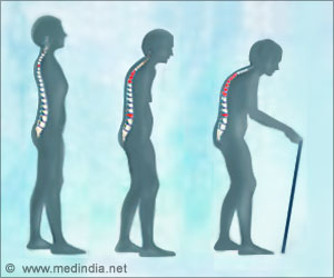 Osteoporosis Risk Could Increase Or Decrease According to The Dosage of Statins Osteoporosis Risk Could Increase Or Decrease According to The Dosage of Statins