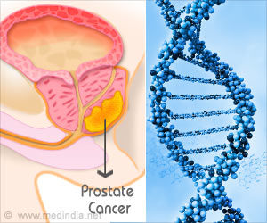 Prostate Cancer Risk Can Be Lowered by Statins Prostate Cancer Risk Can Be Lowered by Statins
