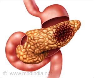 New Way to Hit Pancreatic Cancer With Radiation Identified New Way to Hit Pancreatic Cancer With Radiation Identified