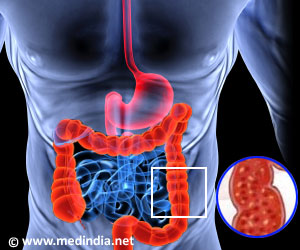 Scientists are Working on a Medicine for Ulcerative Colitis Scientists are Working on a Medicine for Ulcerative Colitis