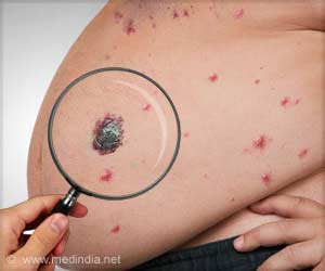 Weight Loss Surgery Linked to a Reduced Risk of Skin Cancer Weight Loss Surgery Linked to a Reduced Risk of Skin Cancer