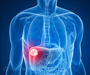 Liver Cancer Deaths Soar by 50 Percent in Last 10 Years: Study Liver Cancer Deaths Soar by 50 Percent in Last 10 Years: Study