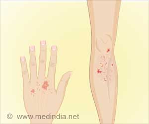 Vaginal Delivery Linked to Reduced Pediatric Allergies Vaginal Delivery Linked to Reduced Pediatric Allergies