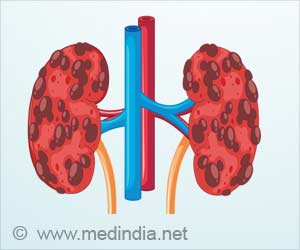 New Tool can Predict 5-year Risk of Chronic Kidney Disease New Tool can Predict 5-year Risk of Chronic Kidney Disease