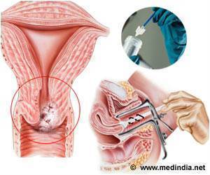Contraceptive Drug MPA Shows Promise in Cervical Cancer Prevention Contraceptive Drug MPA Shows Promise in Cervical Cancer Prevention