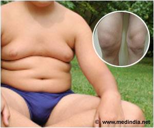 Down Syndrome Kids at Increased Risk for Erosive Arthritis Down Syndrome Kids at Increased Risk for Erosive Arthritis