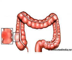 High-Fat Diet May Up Colon Cancer Risk High-Fat Diet May Up Colon Cancer Risk