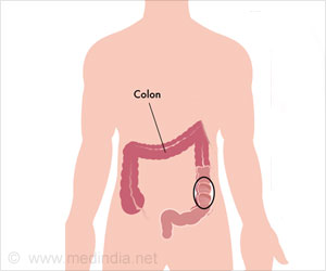 Colon Cancer Diagnosis Boosted By Using Imaging Technique Colon Cancer Diagnosis Boosted By Using Imaging Technique