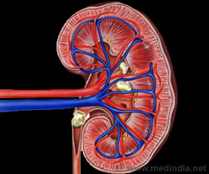 Need for Renal Replacement Therapy is Rising: Study Need for Renal Replacement Therapy is Rising: Study