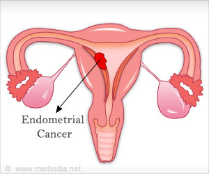 Menopause: Key Factor in Endometrial Cancer Menopause: Key Factor in Endometrial Cancer