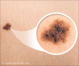 Skin Cancer Mystery Revealed in Yin and Yang Protein: Study Skin Cancer Mystery Revealed in Yin and Yang Protein: Study
