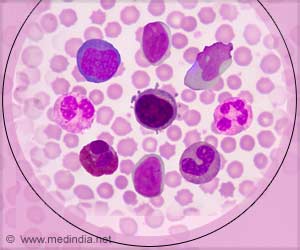 Link Between Heart Failure Risk and Acute Leukemia Discovered Link Between Heart Failure Risk and Acute Leukemia Discovered