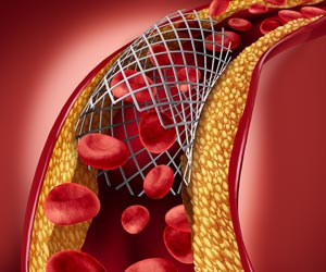 Blood Clots: New Insights Blood Clots: New Insights