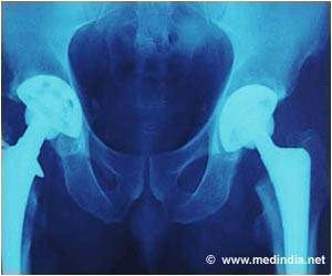 Customized Implant for Hip Replacement Tested Customized Implant for Hip Replacement Tested