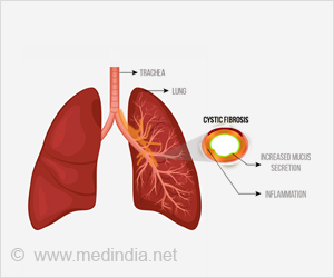 Why Some With Cystic Fibrosis Are Less Prone to Infection? Why Some With Cystic Fibrosis Are Less Prone to Infection?