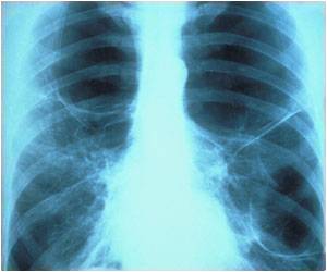 Deep Learning Improves Chest X-ray Interpretation Deep Learning Improves Chest X-ray Interpretation