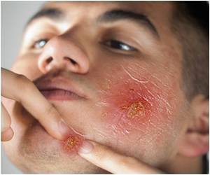 High dose Brachytherapy Holds Promise in Treating Skin Cancer High dose Brachytherapy Holds Promise in Treating Skin Cancer